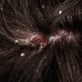 types of dandruff